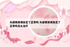 头部银屑病自愈了正常吗 头部银屑病自愈了正常吗怎么治疗