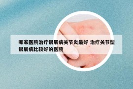 哪家医院治疗银屑病关节炎最好 治疗关节型银屑病比较好的医院