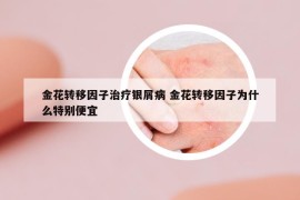 金花转移因子治疗银屑病 金花转移因子为什么特别便宜