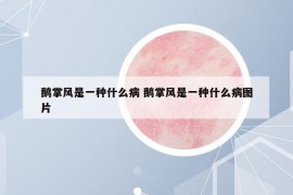 鹅掌风是一种什么病 鹅掌风是一种什么病图片