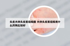 头皮大块头皮屑结痂图 大块头皮屑结痂用什么药物比较好