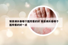 银屑病长春哪个医院看的好 银屑病长春哪个医院看的好一点