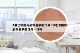 T淋巴细胞与副银屑病的作用 t淋巴细胞与副银屑病的作用一样吗