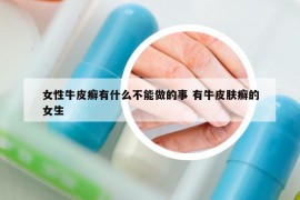 女性牛皮癣有什么不能做的事 有牛皮肤癣的女生