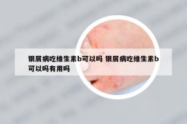 银屑病吃维生素b可以吗 银屑病吃维生素b可以吗有用吗