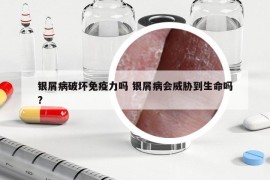 银屑病破坏免疫力吗 银屑病会威胁到生命吗?