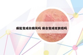 癣能变成白癜风吗 癣会变成皮肤癌吗