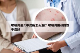 眼睛周边长牛皮癣怎么治疗 眼睛周围顽固性牛皮鲜