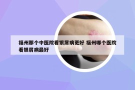 福州那个中医院看银屑病更好 福州哪个医院看银屑病最好