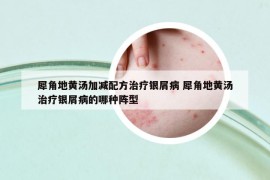 犀角地黄汤加减配方治疗银屑病 犀角地黄汤治疗银屑病的哪种阵型