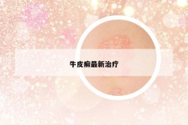 牛皮癣最新治疗