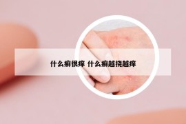 什么癣很痒 什么癣越挠越痒