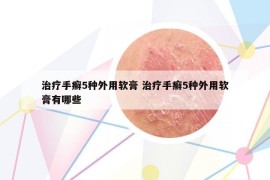 治疗手癣5种外用软膏 治疗手癣5种外用软膏有哪些