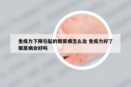 免疫力下降引起的银屑病怎么治 免疫力好了银屑病会好吗