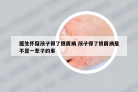 医生怀疑孩子得了银屑病 孩子得了银屑病是不是一辈子的事