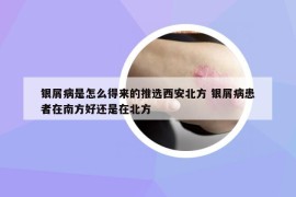 银屑病是怎么得来的推选西安北方 银屑病患者在南方好还是在北方