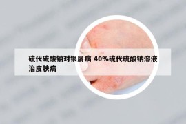 硫代硫酸钠对银屑病 40%硫代硫酸钠溶液治皮肤病