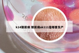 k14银屑病 银屑病ak111是哪里生产