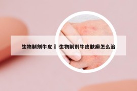 生物制剂牛皮廯 生物制剂牛皮肤癣怎么治