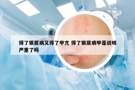 得了银屑病又得了甲亢 得了银屑病甲是说明严重了吗