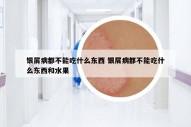 银屑病都不能吃什么东西 银屑病都不能吃什么东西和水果