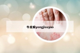 牛皮癣yongjisuyao