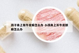 孩子身上有牛皮癣怎么办 小孩身上长牛皮肤癣怎么办