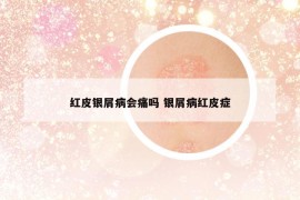 红皮银屑病会痛吗 银屑病红皮症