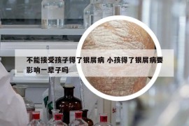 不能接受孩子得了银屑病 小孩得了银屑病要影响一辈子吗