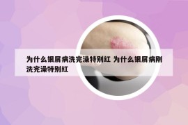 为什么银屑病洗完澡特别红 为什么银屑病刚洗完澡特别红