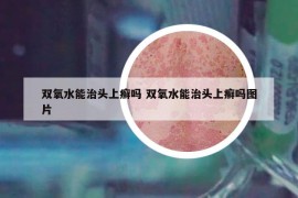 双氧水能治头上癣吗 双氧水能治头上癣吗图片