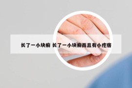 长了一小块癣 长了一小块癣而且有小疙瘩