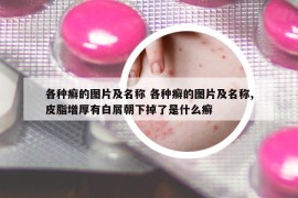 各种癣的图片及名称 各种癣的图片及名称,皮脂增厚有白屑朝下掉了是什么癣