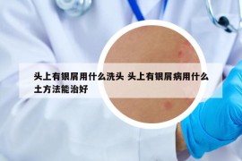 头上有银屑用什么洗头 头上有银屑病用什么土方法能治好