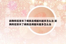 前胸和后背长了癣而且痒越长越多怎么治 前胸和后背长了癣而且痒越长越多怎么治