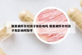 银屑病怀孕对孩子有影响吗 银屑病怀孕对孩子有影响吗知乎