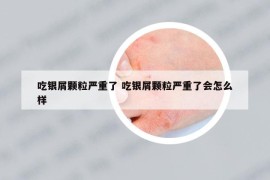 吃银屑颗粒严重了 吃银屑颗粒严重了会怎么样