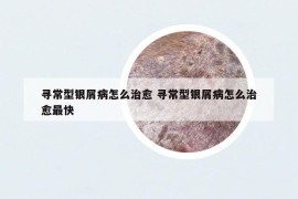 寻常型银屑病怎么治愈 寻常型银屑病怎么治愈最快