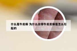 什么是牛皮癣 为什么会得牛皮皮癣是怎么引起的