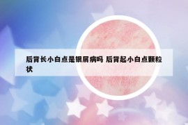 后背长小白点是银屑病吗 后背起小白点颗粒状