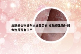 皮肤癣生物针剂大连是否有 皮肤癣生物针剂大连是否有生产