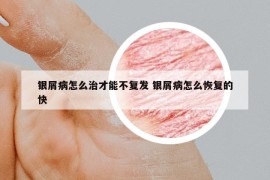 银屑病怎么治才能不复发 银屑病怎么恢复的快