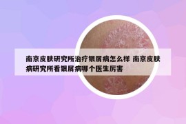 南京皮肤研究所治疗银屑病怎么样 南京皮肤病研究所看银屑病哪个医生厉害