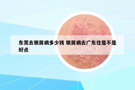 东莞去银屑病多少钱 银屑病去广东住是不是好点