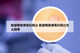 脸部银屑病发红裂口 脸部银屑病发红裂口怎么回事