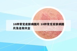 18种常见皮肤病图片 18种常见皮肤病图片及名称大全