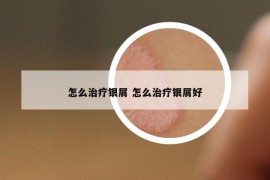 怎么治疗银屑 怎么治疗银屑好