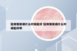 轻微银屑病什么时候能好 轻微银屑病什么时候能好啊