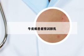 牛皮癣患者擦润肤乳