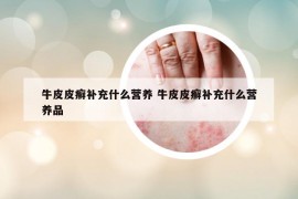 牛皮皮癣补充什么营养 牛皮皮癣补充什么营养品